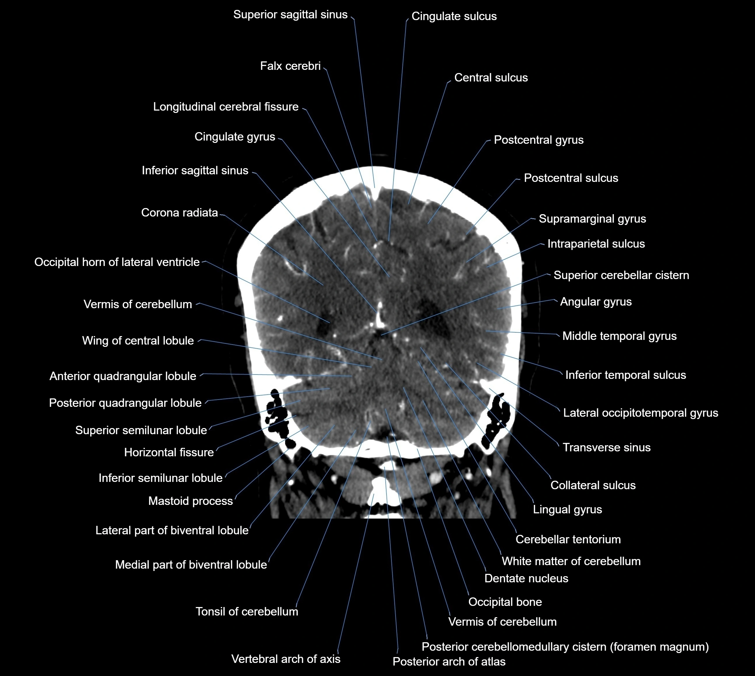 CT Brain coronal cross sectional radiology anatomy image  -img-00001-034.webp